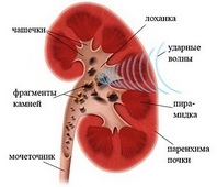 Лечение песка в почках Лечение песка в почках