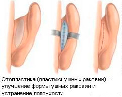 Пластика ушных раковин Пластика ушных раковин